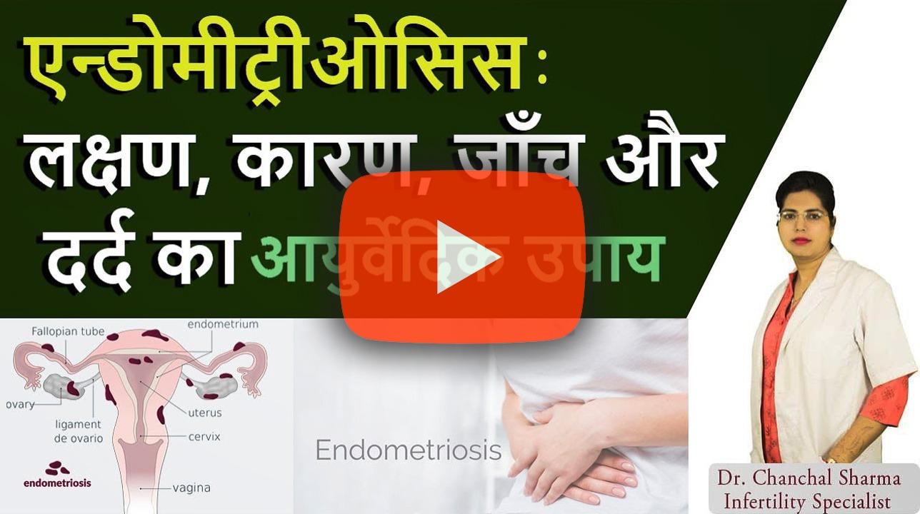 Endometriosis Causes, Symptoms, Diagnosis & Treatment and Success Story